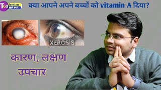 Vitamin A deficiency कैसे ठीक करें  xerophthalmia  conjunctival xerosis Tension get out [upl. by Wolford]