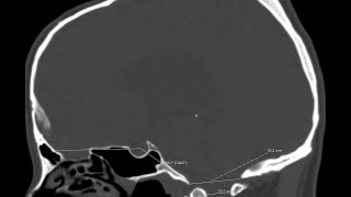 Basilar platybasia and invagination or impression in a case with chronic hydrocephalus [upl. by Maurilla]