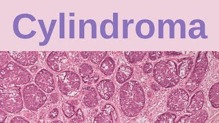 Cylindroma  Pathology mini tutorials [upl. by Pass]