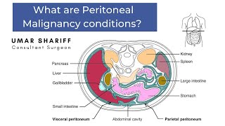 Peritoneal Malignancy conditions [upl. by Noval]