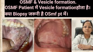 OSMF amp Vesicle formationOSMF Patient में Vesicle formation होता है तो क्या Biopsy जरूरी हैOSmf pt [upl. by Strepphon415]