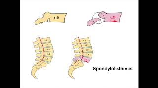 Spondylolisthesis [upl. by Ryan]