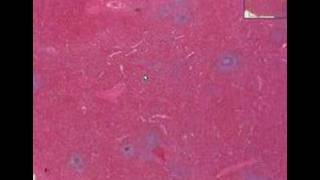 Histopathology SpleenHereditary spherocytosis [upl. by Delamare]