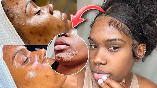 My Chemical Peel Transformation  Part 1 [upl. by Quintus]