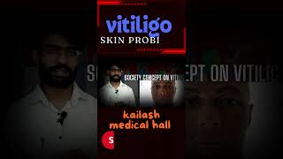 Vitiligo fact Nepali 2024 [upl. by Clovis339]