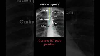 Correct ET endotracheal  tube position 172 chest Xray tubes Quiz radiologychannel007 [upl. by Nitsirk515]