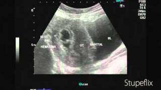 Ultrasound video of subchorionic hematoma early pregnancy [upl. by Pardo]