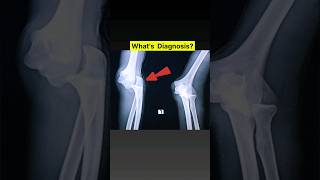 Fracture amp Dislocation Elbow joint Xray xray shorts [upl. by Ellenij283]