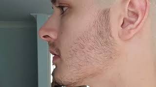 Minoxidil Beard Growth  3 Month Transformation  BEFORE and AFTER [upl. by Behlau]