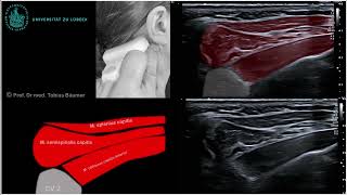 Sonographische Darstellung der kurzen Nackenmuskeln [upl. by Aihsemat]