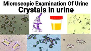 Crystals present in Urine  Urinary crystals  Normal crystals and abnormal crystals [upl. by Mikkel]