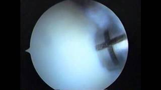 Knee arthroscopy  OCD Mosaicplasty [upl. by Nahtnamas]