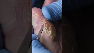 Scraping THICK TOE CALLUS Part 2 callus callusremoval [upl. by Kenrick]