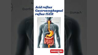 quotUnderstanding Acid Reflux Causes Symptoms and Treatmentsquot shorts gerd acidrefluxsymptoms [upl. by Siusan305]