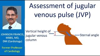 Assessment of jugular venous pulse JVP [upl. by Noell]