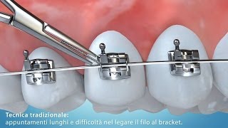 Video Animazione 3D tecnica di allineamento dentale con bracket [upl. by Otanod]