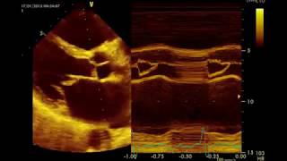 Insuffisance mitrale Sévère par rupture de cordagequotMitral Prolapsequot القصور التاجي الحاد [upl. by Fee]