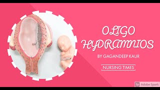 OLIGOHYDRAMNIOS Unit7 OBG HIGH RISK PREGNANCY [upl. by Vic]