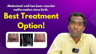 vascular malformation treatment in Hyderabad Dr Shaileshkumar at CitiVascularCentre  malformation [upl. by Nalyac]