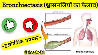 Bronchiectasis in hindi श्वासनलियों का फुल कर जकड़ जाना क्या है कारण लक्षण और उपचार  Episode 31 [upl. by Dream]