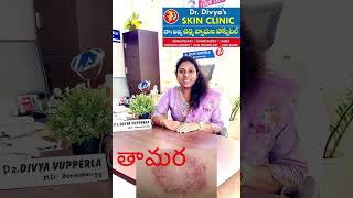 Skin fungus infectiontreatment tinea cruris divyaskinclinic drdivyavupperla Khammam khammam [upl. by Yrian]