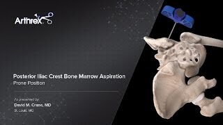 Posterior Iliac Crest Bone Marrow Aspiration  Prone Position [upl. by Yrallih]