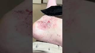 Eczema psoriasis asmr scratching day 7 eczema psoriasis scratchasmr [upl. by Yrebmik]