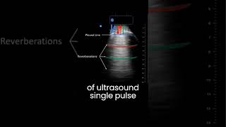 Lung Ultrasound Alines Reverberation Artifact pocus ultrasound lungultrasound pneumothorax [upl. by Quinlan]