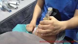 Airway Management with Airtraq in difficult airway situation [upl. by Alic10]