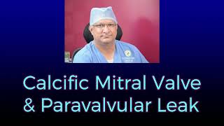 Calcific Mitral Valve and Paravalvar Leak Part 1 [upl. by Edla]