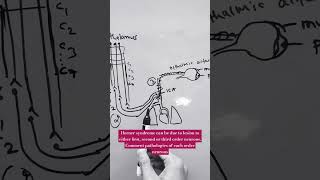 HORNER SYNDROME  lateral medullary syndrome lung apex tumor internal carotid dissection [upl. by Ttiwed292]