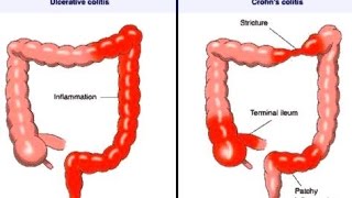 Crohn Disease [upl. by Evers30]