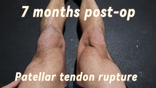 7 months post op Patellar tendon rupture [upl. by Ahsela]