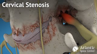 Cervical stenosis [upl. by Jemimah]