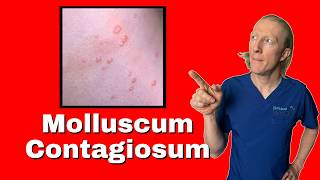 Molluscum Contagiosum causes diagnosis and treatments [upl. by Alphonso]