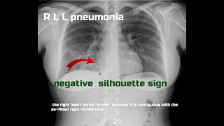 Basic semiology of chest radiology illustrated by clinical casesSilhouette Sign [upl. by Anenahs]