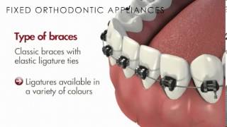 MalocclusionFixed Orthodontic AppliancesBraces [upl. by Ahsotan]