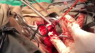 Heartworm Surgical Extraction  Caval Syndrome 62 heartworms extracted [upl. by Ynnek]