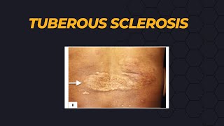 Tuberous Sclerosis [upl. by Emmuela]