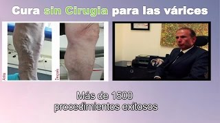 Cura para venas varices SIN CIRUGIA en Bogota Colombia  Tratamiento Ulceras varicosas Linfedema [upl. by Birkner]