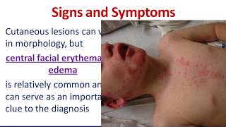 Dermatologic Emergencies 3 Drug Reaction with Eosinophilia and Systemic Symptoms DRESS SYNDROME [upl. by Kasevich]