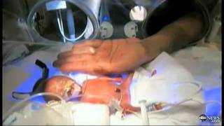 Baby Melinda Video Inspires Miracle Premature Baby Size of Human Fist to Go Home [upl. by Ras]