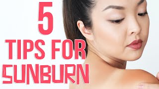 HOW TO Get Rid of Sunburn FAST [upl. by Wilterdink]