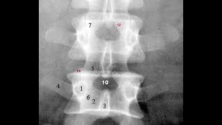 Radiological Anatomy of the Lumbar Spine Xray MRI amp CT Covered [upl. by Clarice]