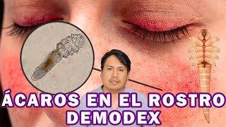 COMO ELIMINAR AL DEMODEX [upl. by Philips]