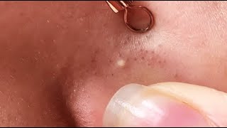 HOW YOU CAN REMOVE BLACKHEADS FROM NOSE AT HOME  RELAXING VIDEO WITH ELA [upl. by Daley]