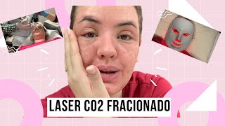 Laser de CO2 Fracionado  Vale a Pena para Cicatrizes de Acne [upl. by Adnirem870]