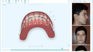 Quick Tip  Bite Correction Visualization in Aligners [upl. by Levitan]