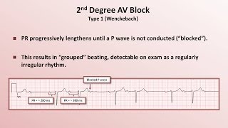 Intro to EKG Interpretation  AV Block [upl. by Ritch]