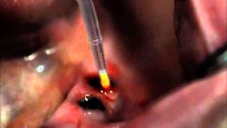 Treating PeriImplant Mucositis [upl. by Vernice]